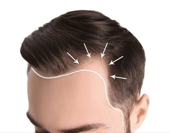 تصویر کاشت مو در ناحیه خالی سر