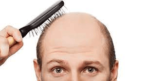 تصویر سن کاشت مو در مردان